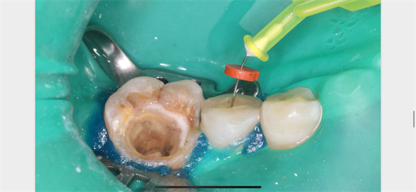 The Rct for big cyst