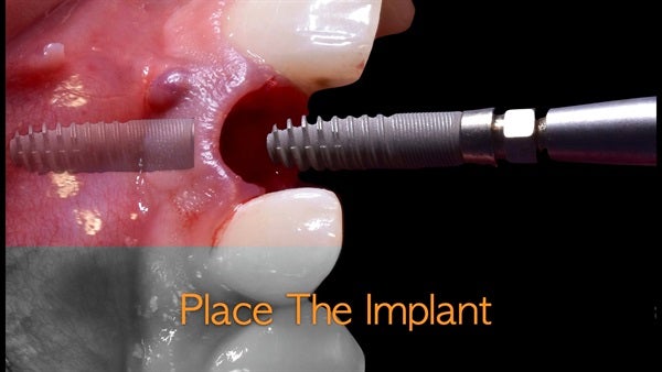 The   One-Time   Socket   Abutment Just    For   Incisor