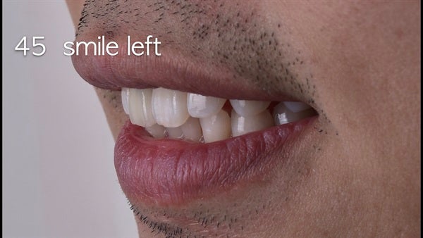 The   One-Time   Socket   Abutment Just    For   Incisor