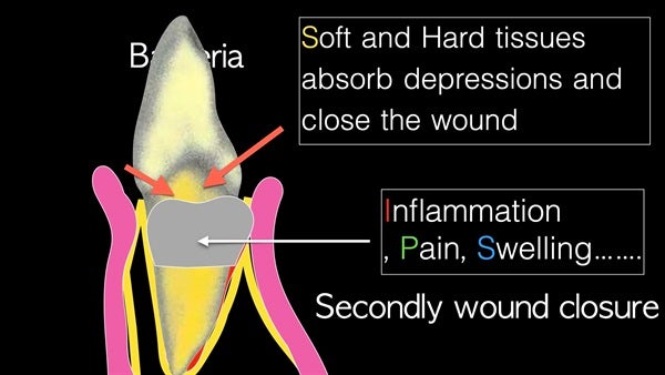 The   One-Time   Socket   Abutment Just    For   Incisor