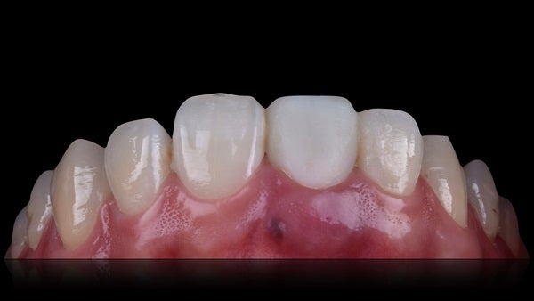 The   One-Time   Socket   Abutment Just    For   Incisor