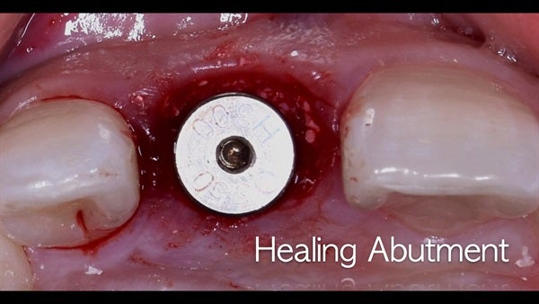 The   One-Time   Socket   Abutment Just    For   Incisor