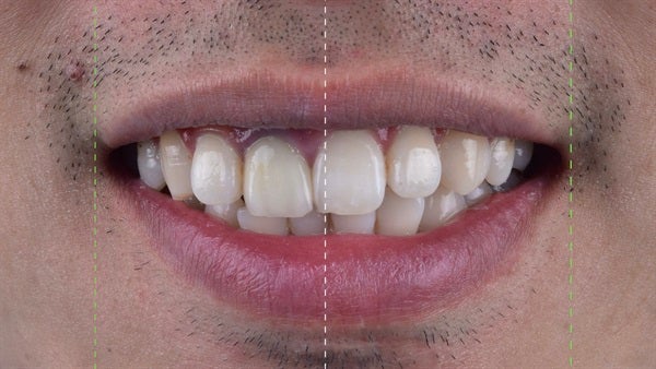 The   One-Time   Socket   Abutment Just    For   Incisor