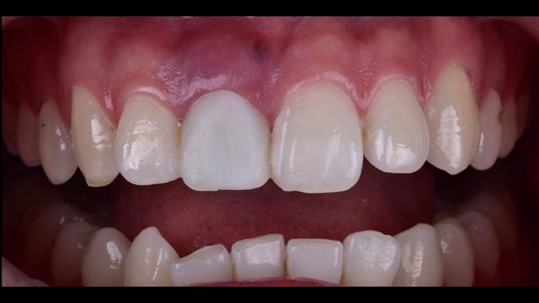 The   One-Time   Socket   Abutment Just    For   Incisor