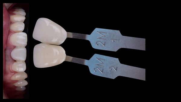 The   One-Time   Socket   Abutment Just    For   Incisor