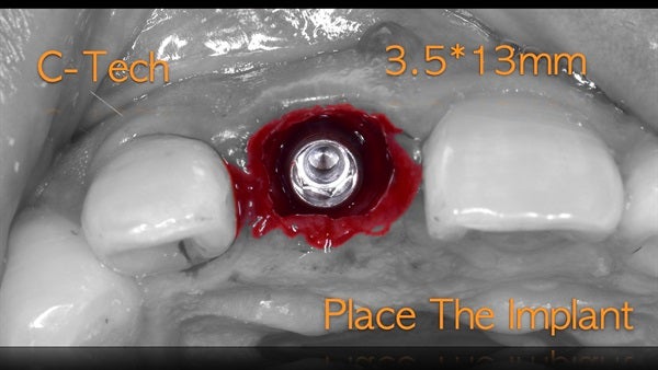 The   One-Time   Socket   Abutment Just    For   Incisor