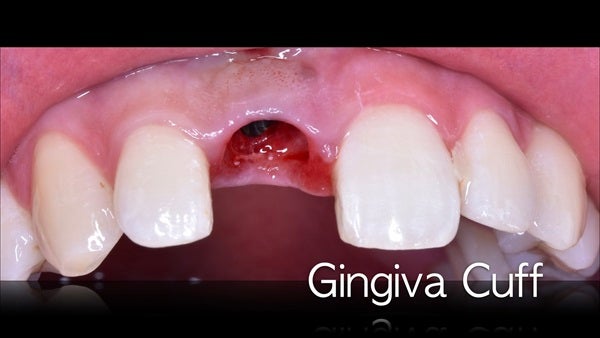 The   One-Time   Socket   Abutment Just    For   Incisor