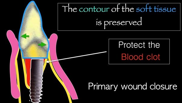 The   One-Time   Socket   Abutment Just    For   Incisor