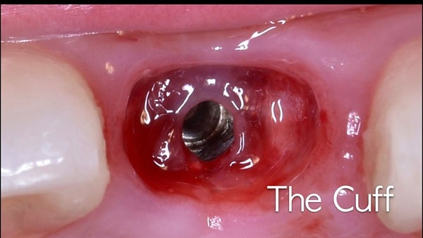 The   One-Time   Socket   Abutment Just    For   Incisor