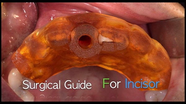 The   One-Time   Socket   Abutment Just    For   Incisor