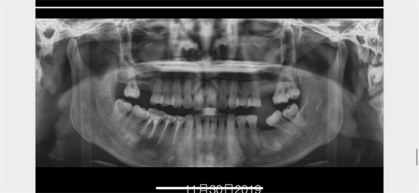The Rct for big cyst