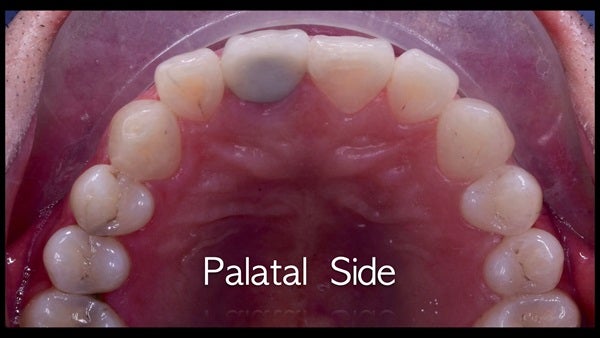 The   One-Time   Socket   Abutment Just    For   Incisor