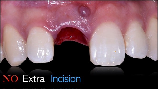 The   One-Time   Socket   Abutment Just    For   Incisor