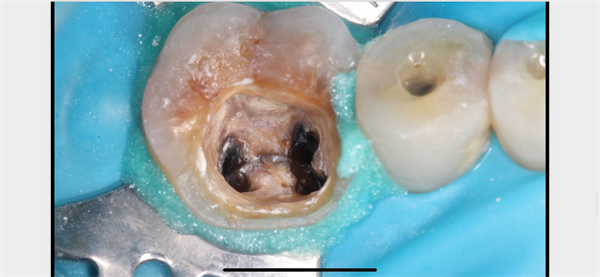 The Rct for big cyst