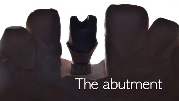 The   One-Time   Socket   Abutment Just    For   Incisor