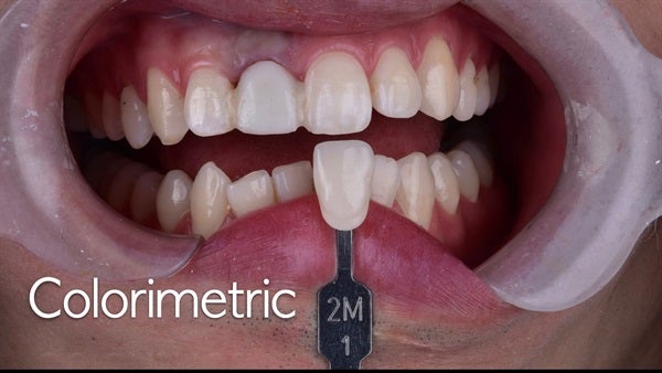 The   One-Time   Socket   Abutment Just    For   Incisor