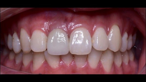 The   One-Time   Socket   Abutment Just    For   Incisor