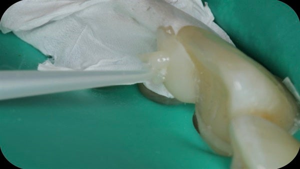 The Immediately  restoration of Central Incisor  on Lingual  Surface 