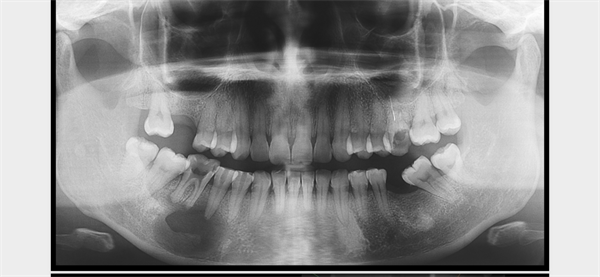 The Rct for big cyst
