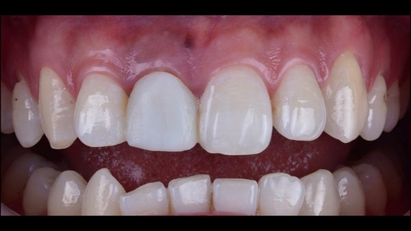 The   One-Time   Socket   Abutment Just    For   Incisor