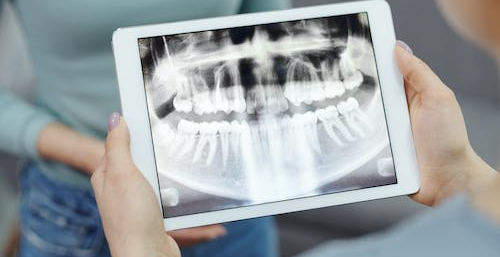All You Need to Know About Cross bite and Its Treatment